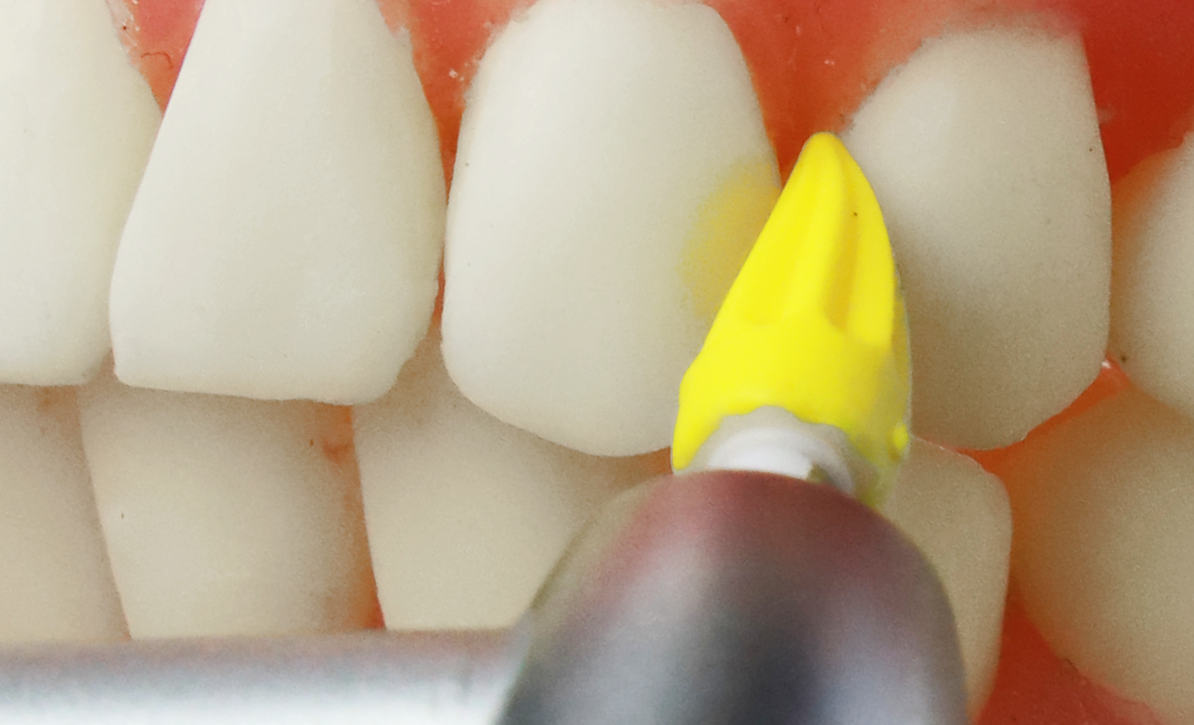 Prophy point braces