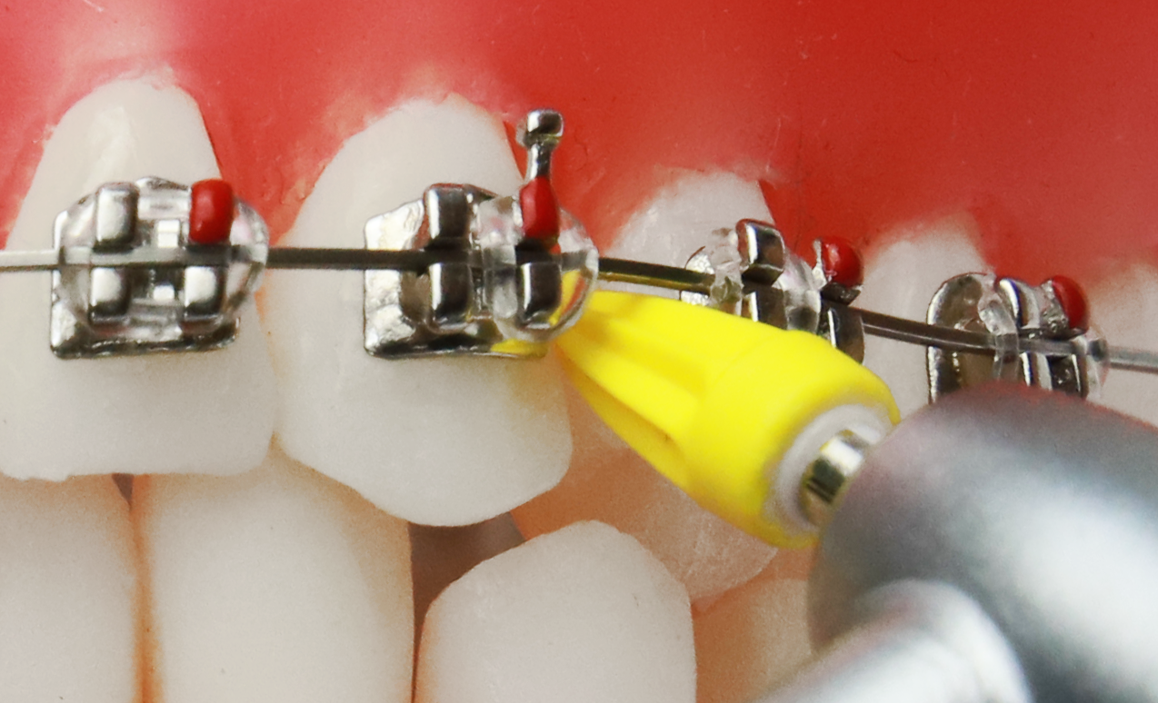 Prophy point braces